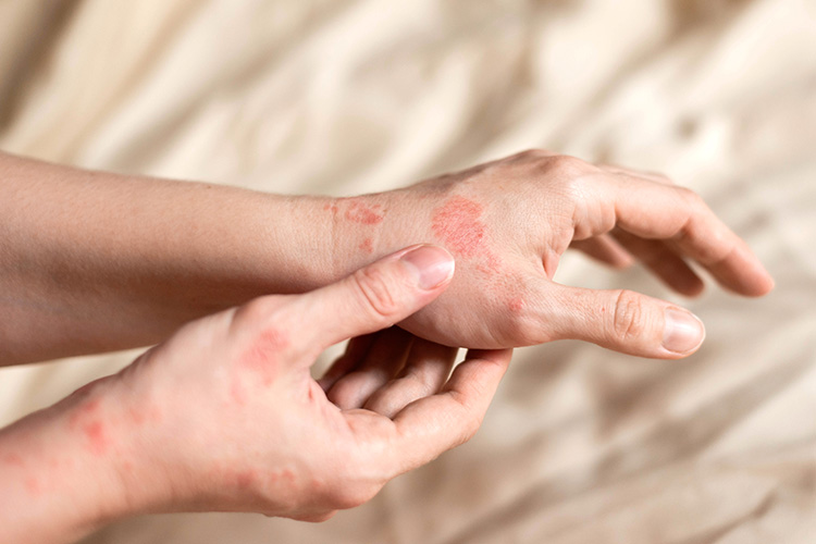 Eczema Treatment in Pune